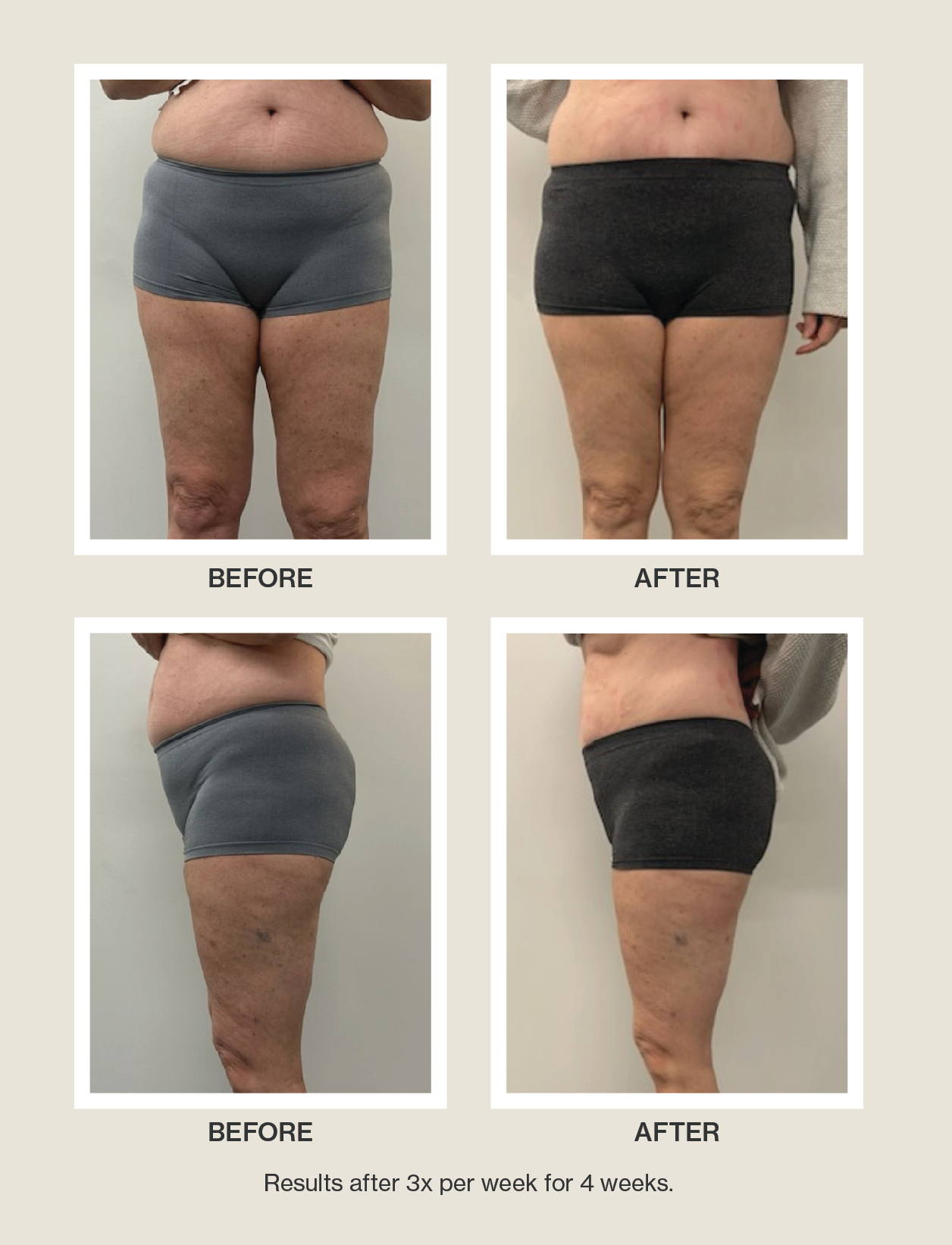 picture of an individual from the stomach down wearing stretch shorts, showing before and after photos of using celluma