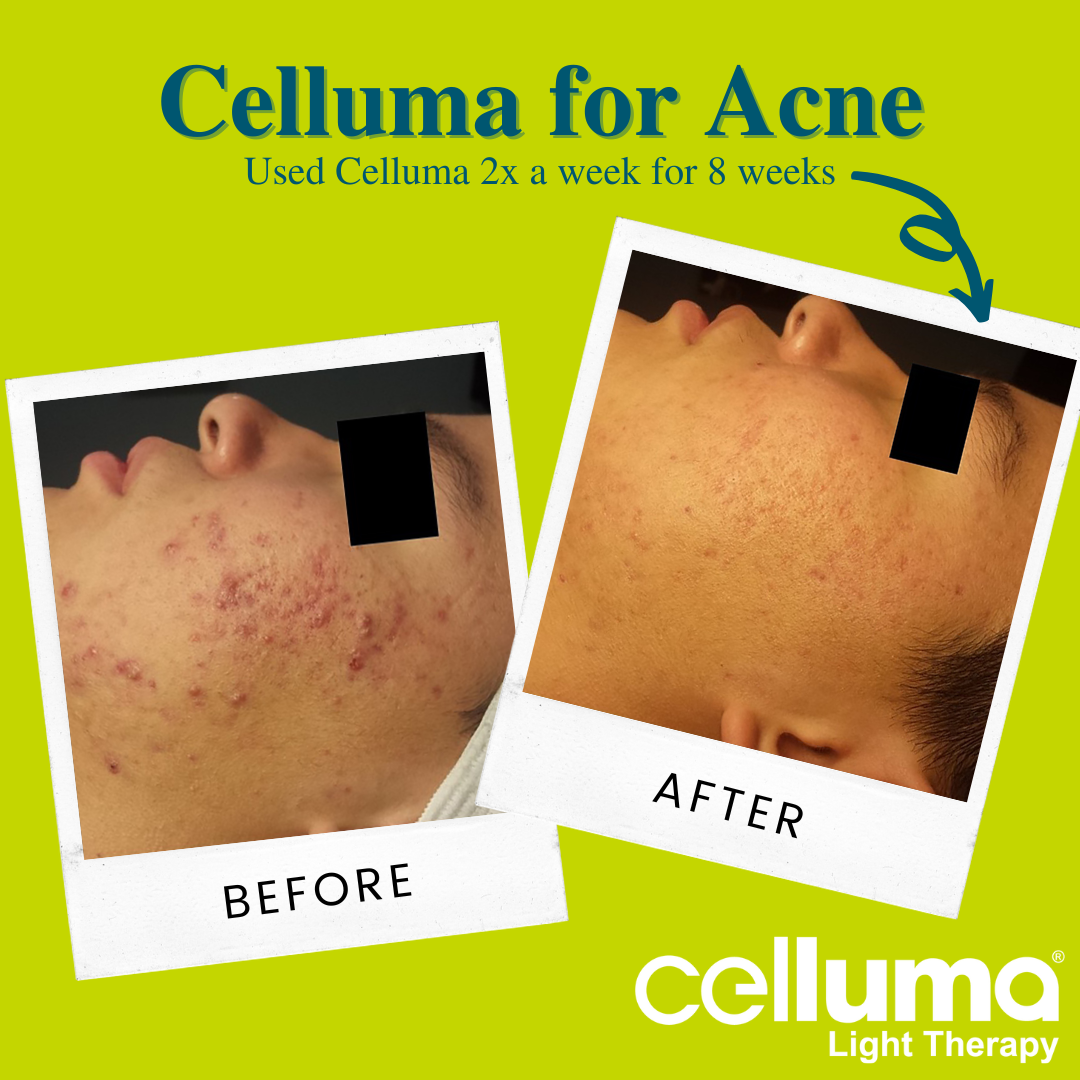 Before and After picture of a woman using Celluma who has acne.