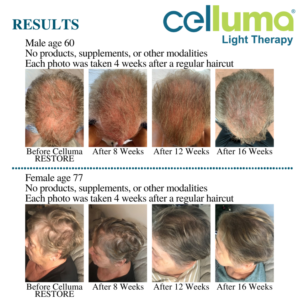 An image of a Male age 60 using Celluma for treating hair loss. Image of his hair before using Celluma and 3 images of using Celluma after a haircut every 4 weeks. (16 weeks total) An image of a femal age 77 of her head before celluma and 3 picture interval every 4 weeks after a regular hair cut. (16 weeks total)