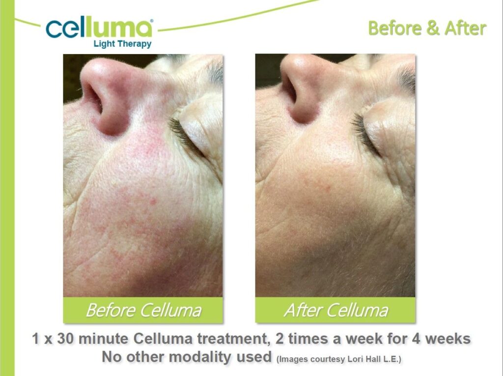 Before and after image of a woman using Celluma, 30 min, 2 times a week for 4 weeks. No other modalities use.