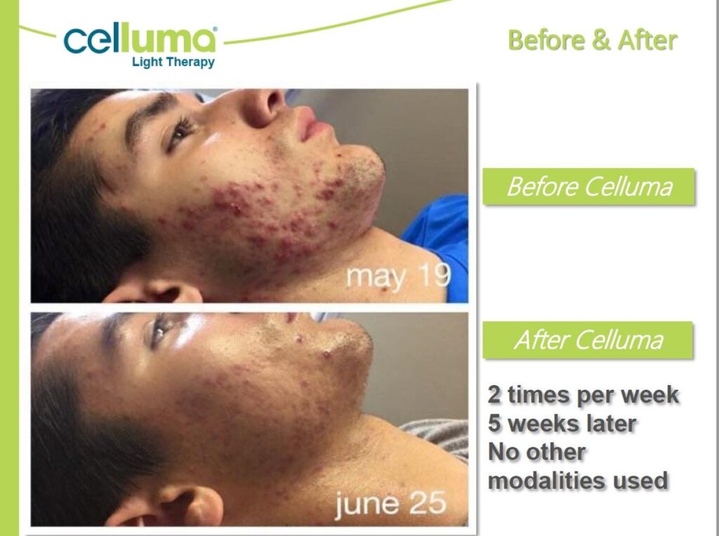 An image of a man using Celluma Before on May 19th and after on June 25th who has acne. He used the celluma 2x per week. The image on June 25th was 5 weeks later with no other modalities used. 