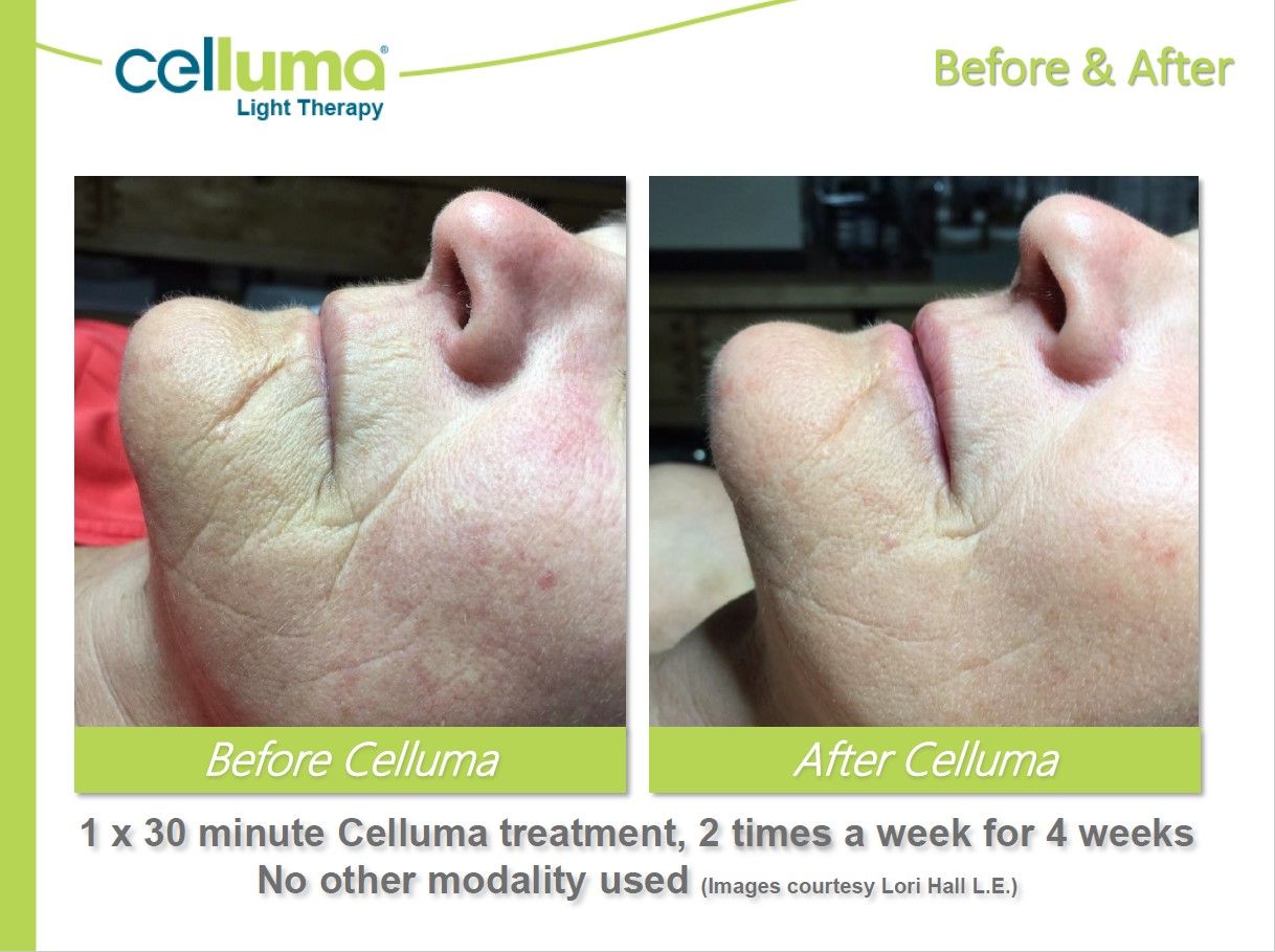 Before and after image of an aging womens lower face before and after using celluma for 4 weeks, 30 min, 2x a week. No other modalities used.