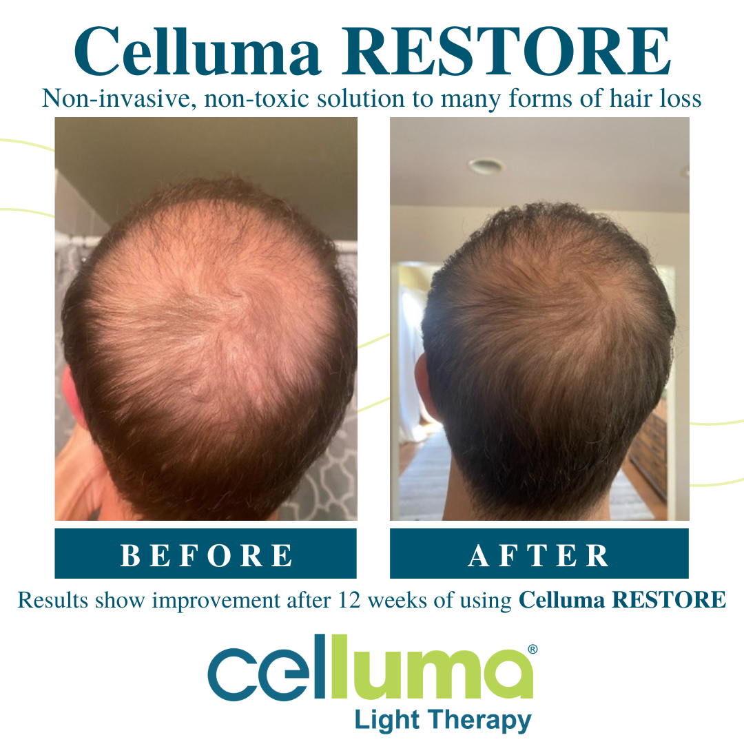 A head of a man using Celluma Restore before and after photos of his hair