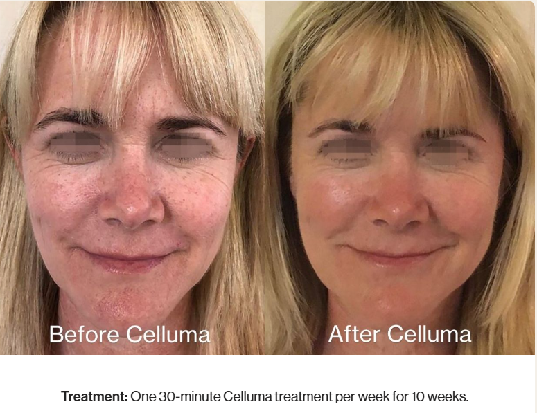 Full Face Antiaging Before and After Results with Celluma